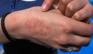 аллергия на латекс от перчаток фото