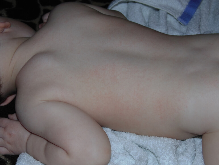 аллергия на стиральный порошок у ребенка фото
