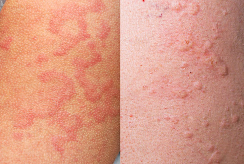 аллергия на цитрусовые симптомы фото